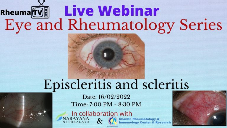 Eye and Rheumatology Series – Episcleritis and Scleritis