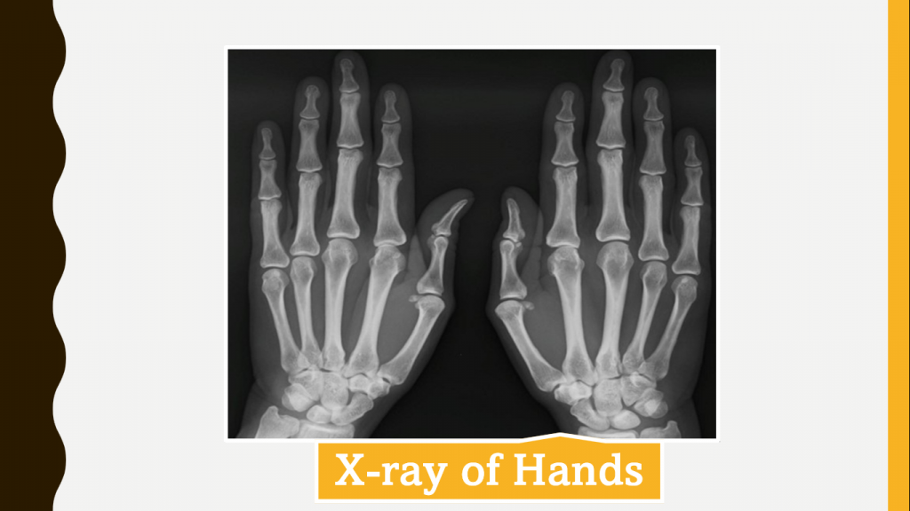xray of hands
