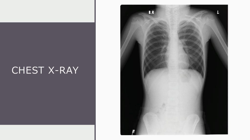Chest x-RAY