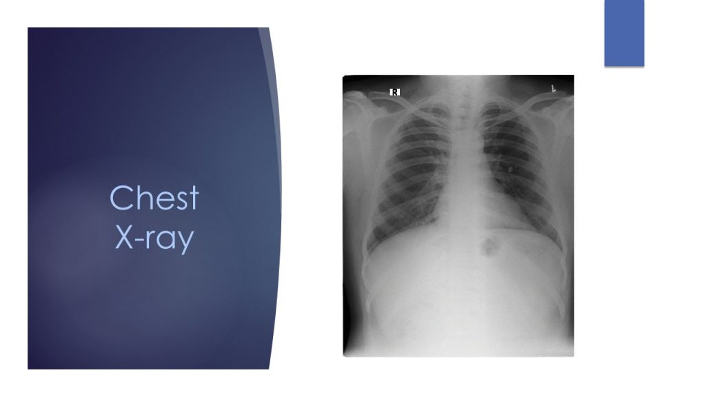 Chest X Ray