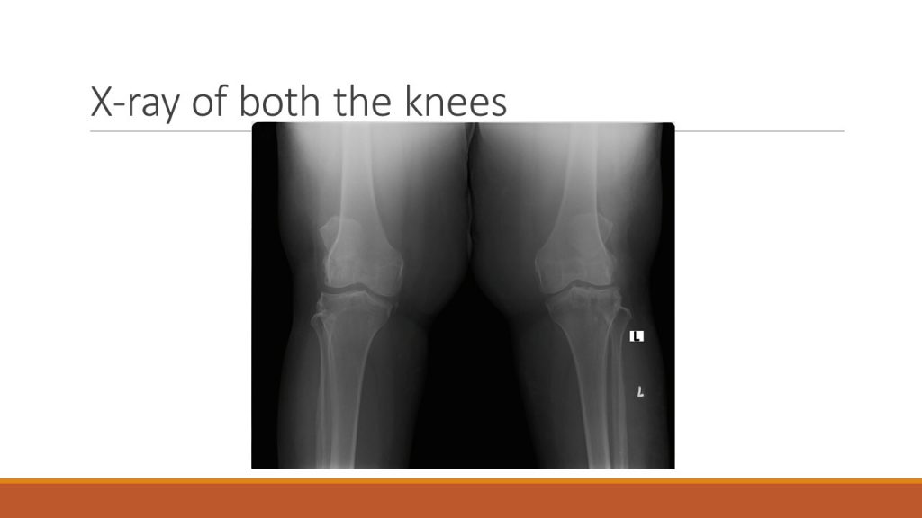 X-ray of both the knees