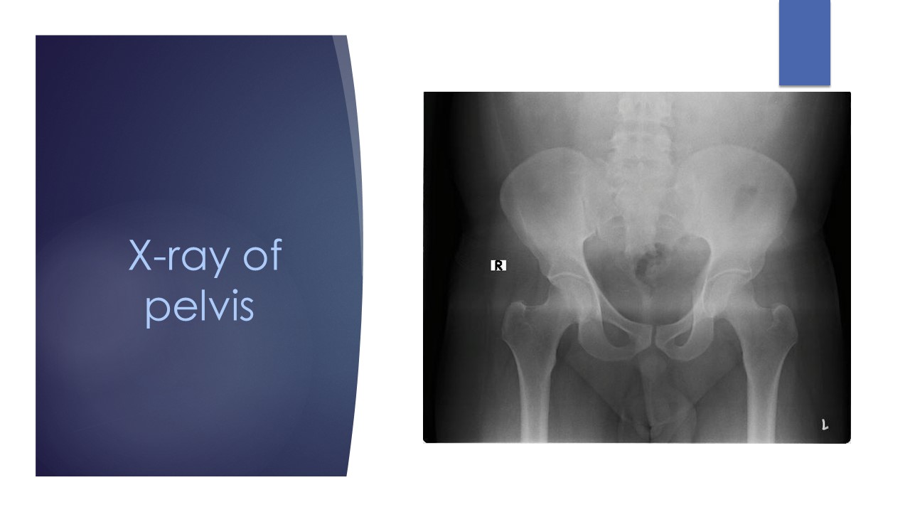 X-ray of pelvis