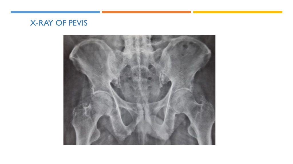 X-RAY OF PEVIS