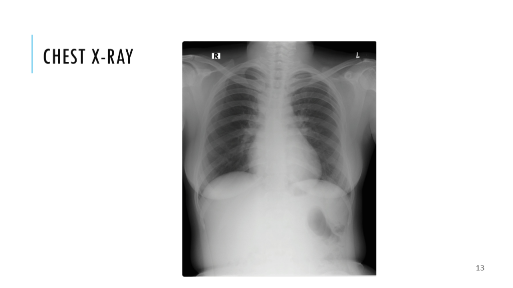 Chest x-ray