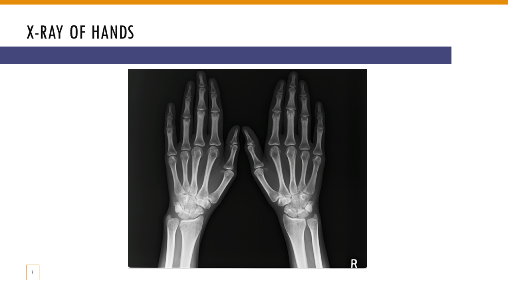 X-Ray of hands