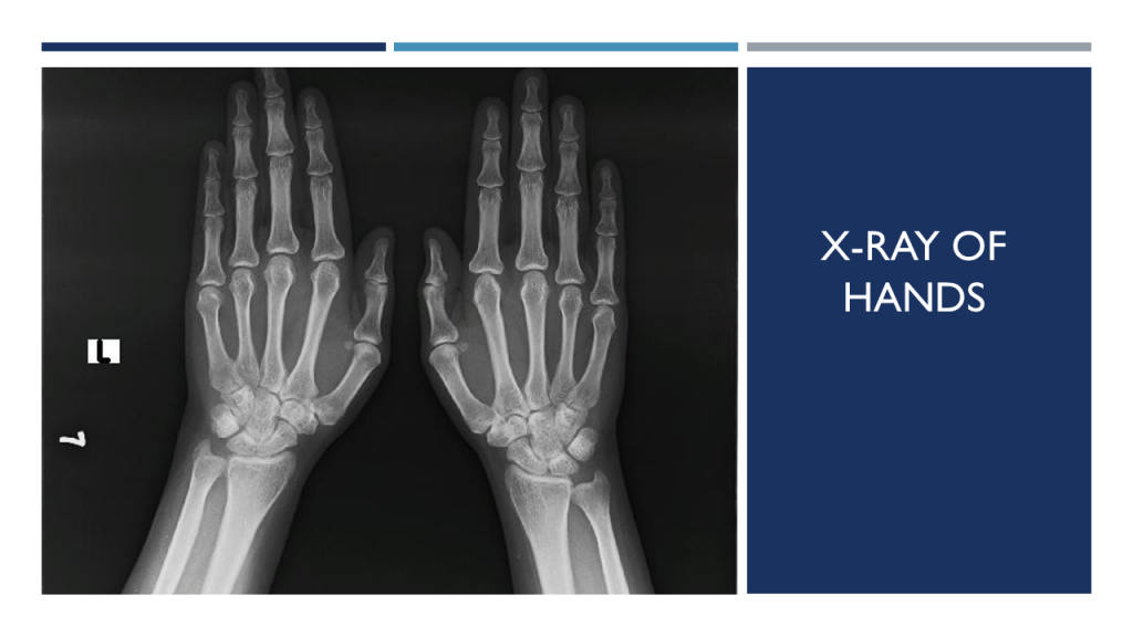 X-RAY of hands
