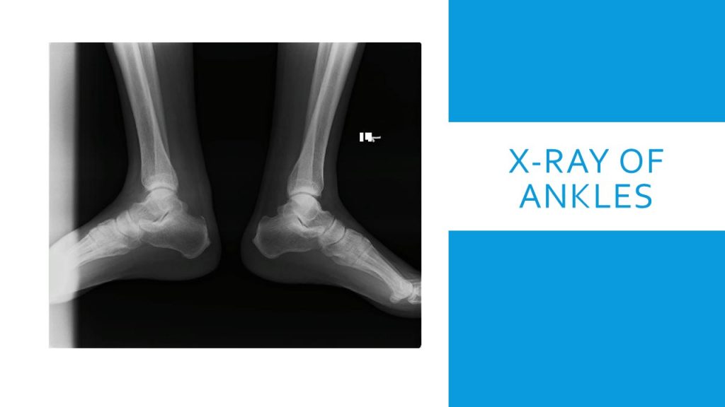 X-ray of ankles