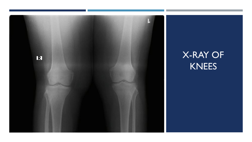 X-ray of knees