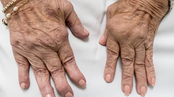 rheumatoid arthritis