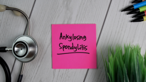 Management of Ankylosing Spondylitis