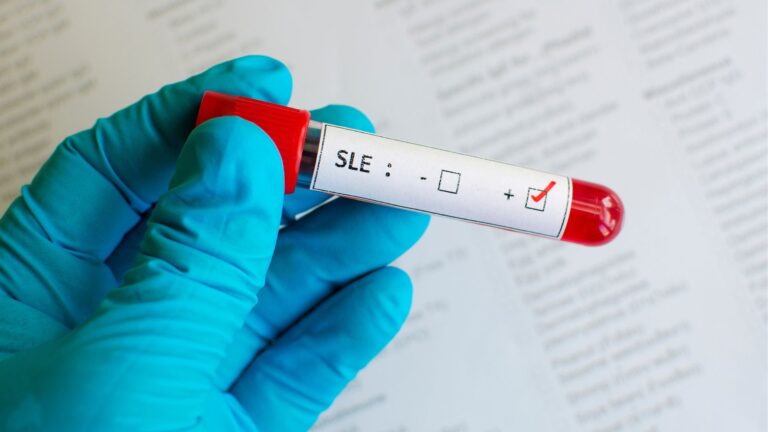 Mycophenolate mofetil reduces severe flares and lower lupus nephritis incidence in patients with early-stage systemic lupus erythematosus