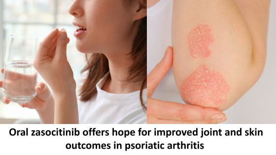 Oral zasocitinib offers hope for improved joint and skin outcomes in psoriatic arthritis