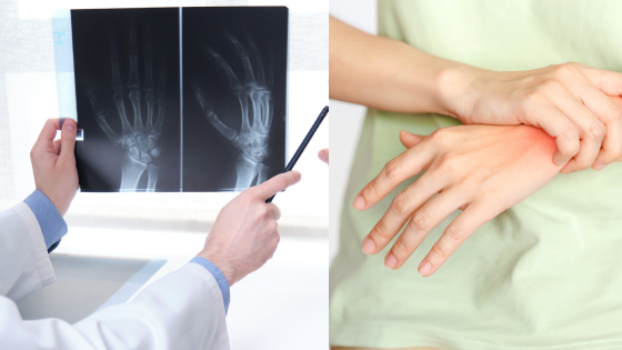 Radiographic non-progression linked to greater low disease activity achievement in psoriatic arthritis patients on secukinumab